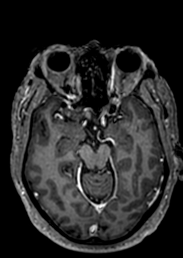 File:Accessory middle cerebral artery (Radiopaedia 73114-83828 Axial T1 C+ 80).jpg