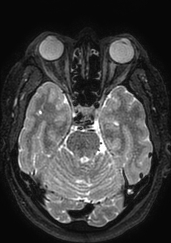 Accessory middle cerebral artery (Radiopaedia 73114-83828 Axial T2 137).jpg