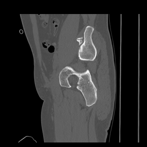 Acetabular and ilial fractures (Radiopaedia 59084-66378 Sagittal bone window 33).jpg