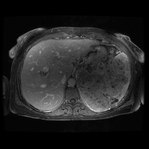 Acinar cell carcinoma of the pancreas (Radiopaedia 75442-86668 Axial T1 C+ fat sat 104).jpg
