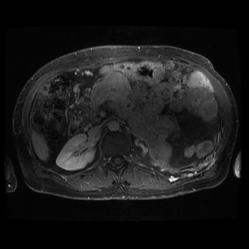 Acinar cell carcinoma of the pancreas (Radiopaedia 75442-86668 Axial T1 C+ fat sat 52).jpg