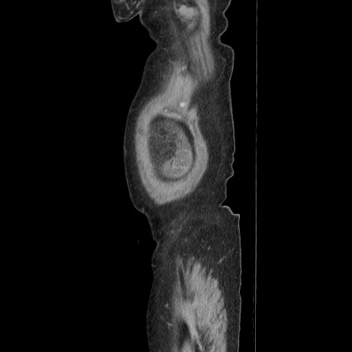 Acinar cell carcinoma of the pancreas (Radiopaedia 75442-86669 Sagittal C+ portal venous phase 26).jpg