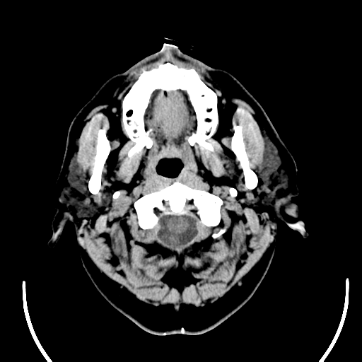 File:Acoustic schwannoma (Radiopaedia 39170-41388 Axial non-contrast 1).png