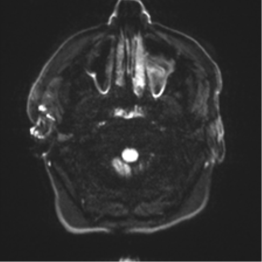 Acoustic schwannoma (Radiopaedia 50846-56358 Axial DWI 28).png