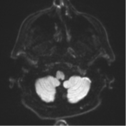 Acoustic schwannoma (Radiopaedia 55729-62281 E 28).png