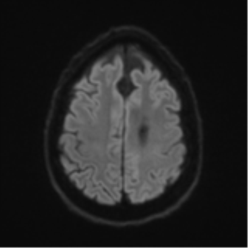 File:Acoustic schwannoma (Radiopaedia 55729-62281 E 49).png