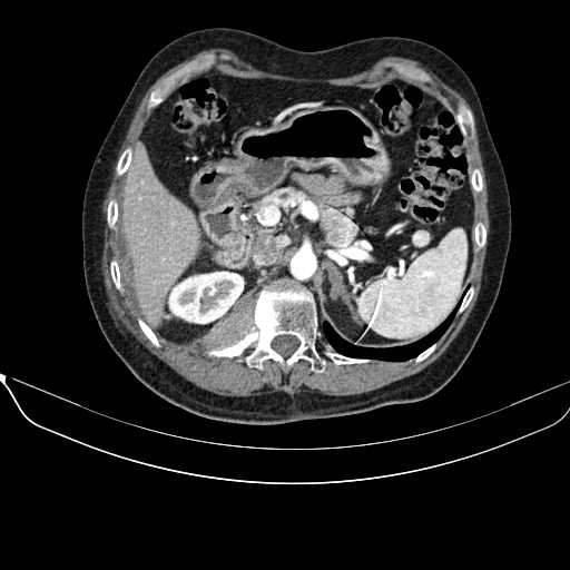 File:Acquired adrenal hyperplasia - due to thymic carcinoid tumor (Radiopaedia 21269-21184 C+ arterial phase 33).jpg