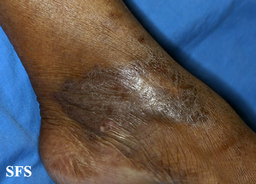 File:Acroangiodermatitis (Dermatology Atlas 2).jpg
