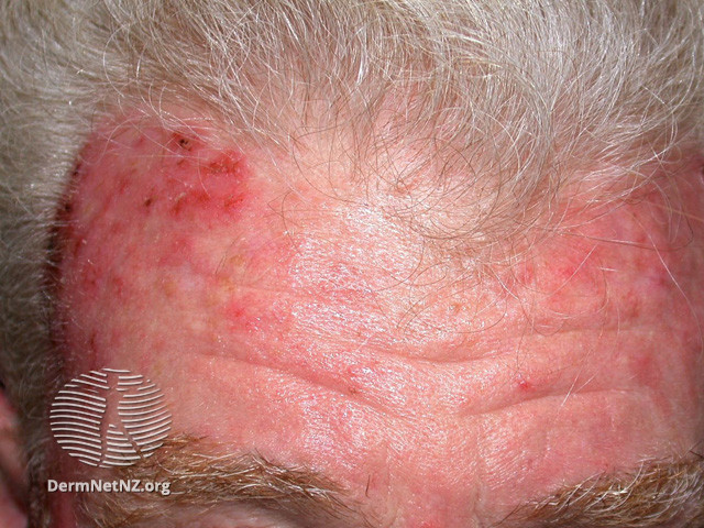 File:Actinic Keratoses treated with imiquimod (DermNet NZ lesions-ak-imiquimod-3747).jpg