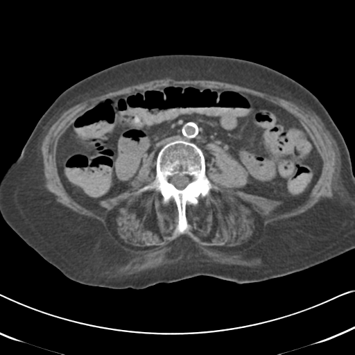 Active bleeding from duodenal ulcer with embolization (Radiopaedia 34216-35481 Axial non-contrast 35).png