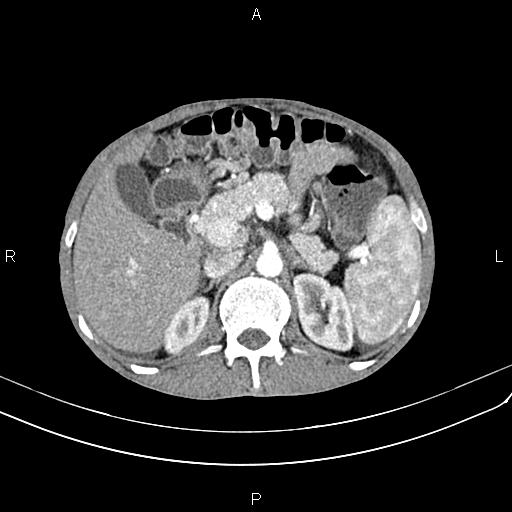 File:Active crohn disease (Radiopaedia 87133-103397 Axial C+ arterial phase 34).jpg
