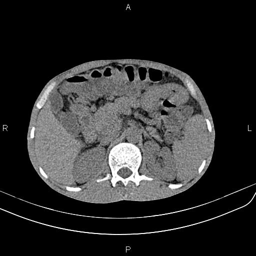 File:Active crohn disease (Radiopaedia 87133-103397 Axial non-contrast 32).jpg