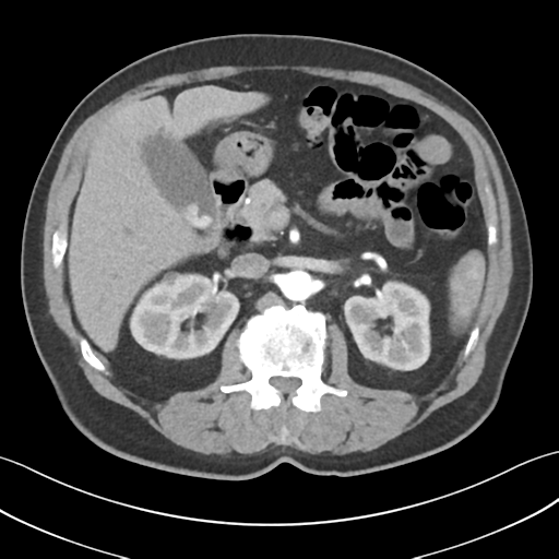 Active diverticular hemorrhage (Radiopaedia 39415-41725 Axial C+ arterial phase 22).png