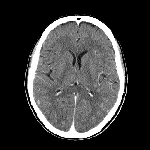File:Active neurocysticercosis before and after therapy (Radiopaedia 71710-82100 Axial C+ delayed 50).jpg