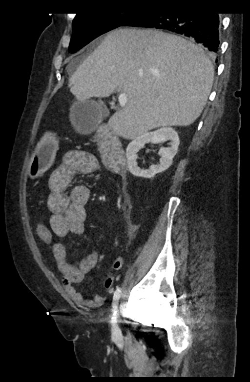 Active renal extravasation with large subcapsular and retroperitoneal hemorrhage (Radiopaedia 60975-68796 Sagittal C+ portal venous phase 153).jpg