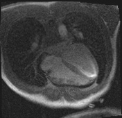 Active right ventricular cardiac sarcoidosis (Radiopaedia 55596-62100 Axial Dynamic perfusion scan MOCO 82).jpg