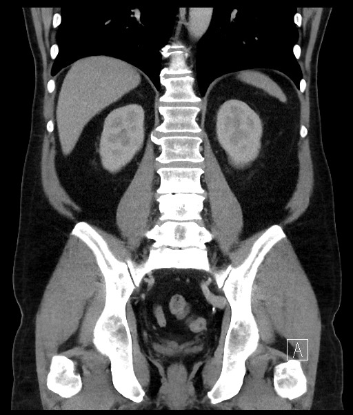 Acute-on-chronic pancreatitis (Radiopaedia 67286-76656 Coronal C+ portal venous phase 52).jpg