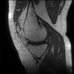 Acute-on-chronic transient lateral patellar dislocation with trochlear dysplasia (Radiopaedia 84099-99349 Sagittal PD 57).jpg