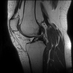 Acute-on-chronic transient lateral patellar dislocation with trochlear dysplasia (Radiopaedia 84099-99349 Sagittal PD 88).jpg