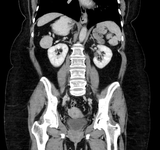 Acute appendicitis, heterotaxy syndrome (Radiopaedia 66884-76202 Coronal C+ portal venous phase 77).jpg