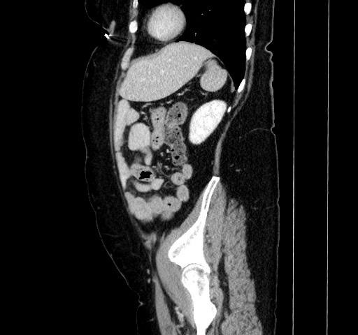 Acute appendicitis, heterotaxy syndrome (Radiopaedia 66884-76202 Sagittal C+ portal venous phase 101).jpg