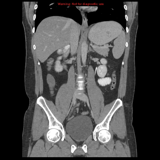 File:Acute appendicitis (Radiopaedia 10498-10973 F 23).jpg