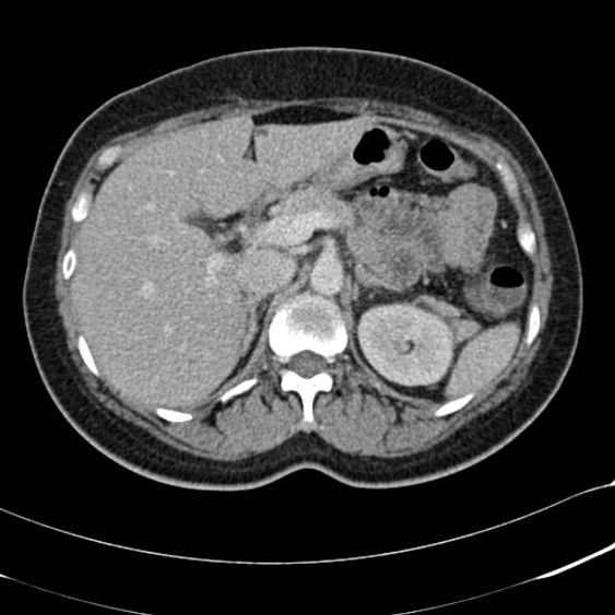 File:Acute appendicitis (Radiopaedia 48792-53822 Axial C+ portal venous phase 32).jpg