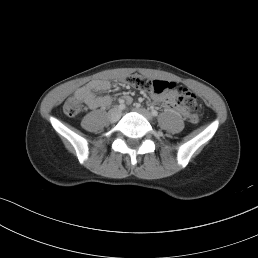 Acute appendicitis (Radiopaedia 62608-70901 Axial C+ portal venous phase 2).jpg
