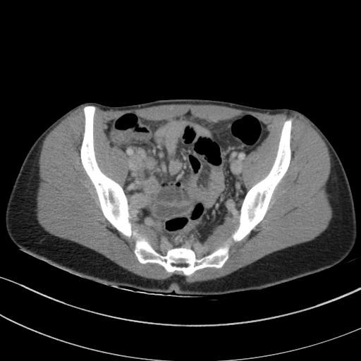 Acute appendicitis (Radiopaedia 62608-70901 Axial C+ portal venous phase 29).jpg