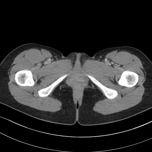 File:Acute appendicitis (Radiopaedia 62608-70901 Axial C+ portal venous phase 74).jpg