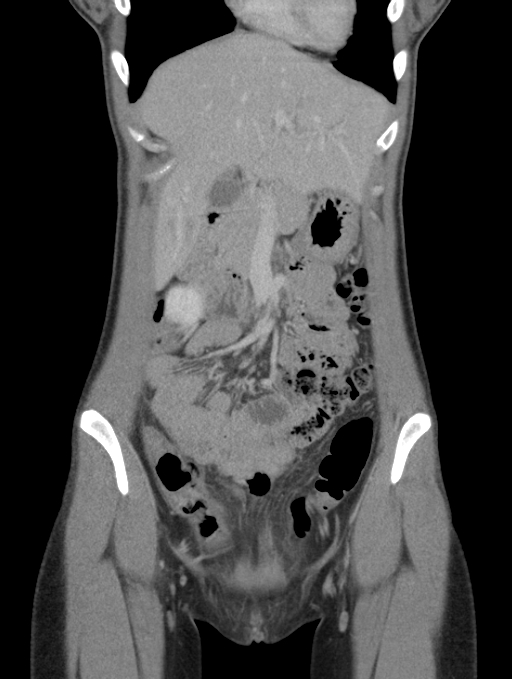 Acute appendicitis (Radiopaedia 62608-70901 Coronal C+ portal venous phase 10).jpg