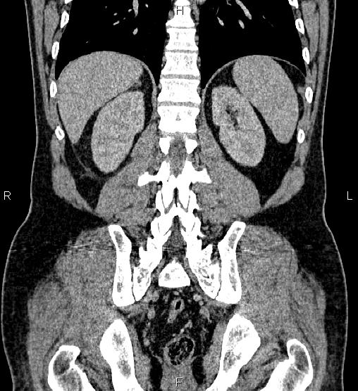 Acute appendicitis (Radiopaedia 84780-100240 Coronal C+ portal venous phase 61).jpg