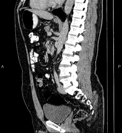 Acute appendicitis (Radiopaedia 84780-100240 Sagittal C+ portal venous phase 58).jpg