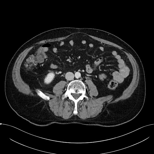 File:Acute appendicitis - large appendicoliths (Radiopaedia 61805-69820 Axial 15).jpg