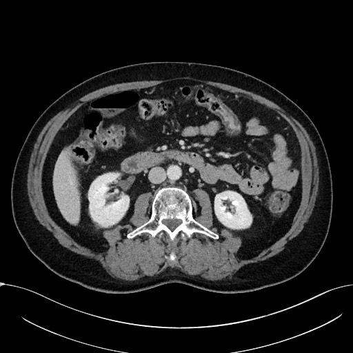 File:Acute appendicitis - large appendicoliths (Radiopaedia 61805-69820 Axial C+ portal venous phase 59).jpg