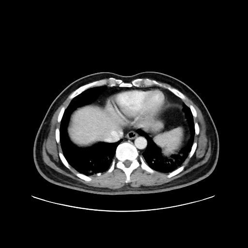 Acute appendicitis and COVID 19 pneumonia (Radiopaedia 76604-88380 Axial C+ portal venous phase 6).jpg