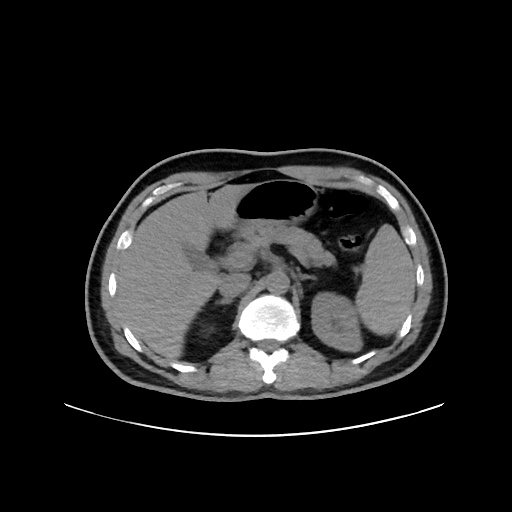 Acute appendicitis and COVID 19 pneumonia (Radiopaedia 76604-88380 Axial non-contrast 60).jpg