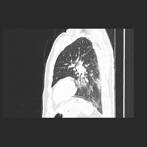 Acute appendicitis and COVID 19 pneumonia (Radiopaedia 76604-88380 Sagittal lung window 68).jpg
