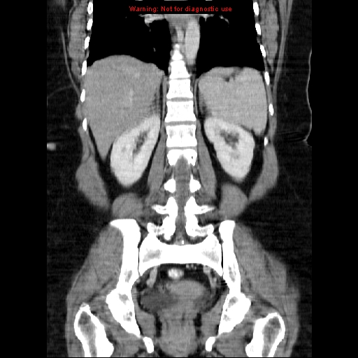 Acute appendicitis complicated by ovarian vein thrombophlebitis (Radiopaedia 16172-15851 Coronal C+ portal venous phase 56).jpg