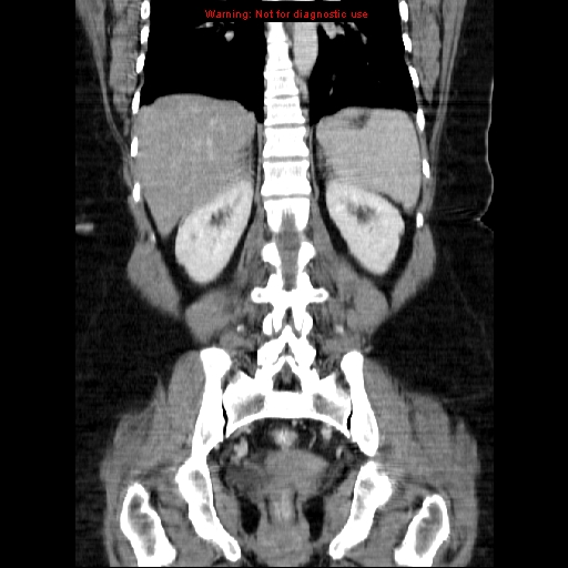 Acute appendicitis complicated by ovarian vein thrombophlebitis (Radiopaedia 16172-15851 Coronal C+ portal venous phase 58).jpg