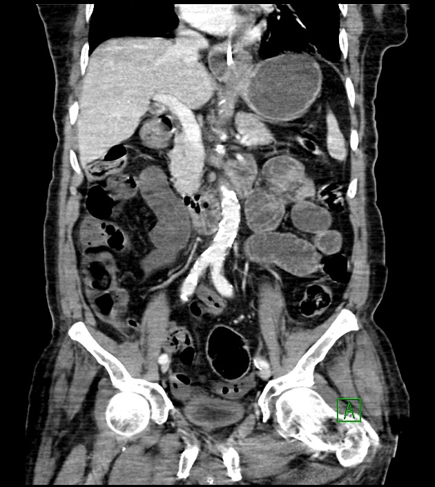 Acute arterial mesenteric ischemia (Radiopaedia 78238-90828 Coronal C+ portal venous phase 49).jpg