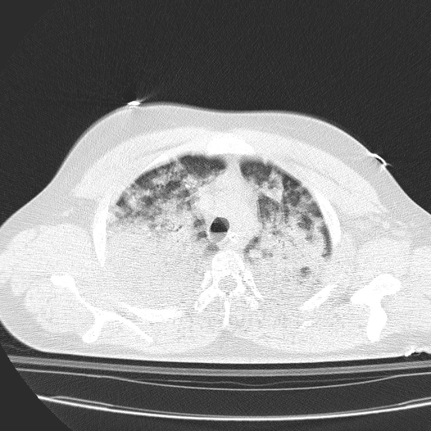 Acute aspiration pneumonitis (Radiopaedia 33605-34703 Axial lung window 29).jpg