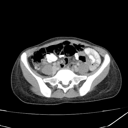 Acute bilateral pyelonephritis (Radiopaedia 74153-84969 Axial C+ portal venous phase 35).jpg