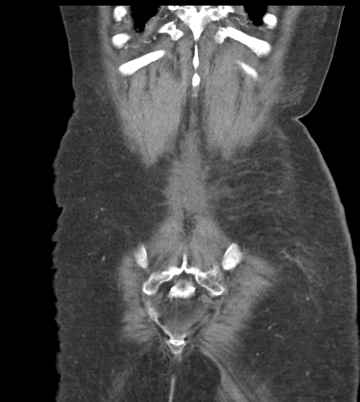 File:Acute bleed from gastric fundus biopsy site (Radiopaedia 35201-36737 D 51).png