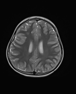 File:Acute cerebellar ataxia (Radiopaedia 61487-69446 Axial T2 16).jpg