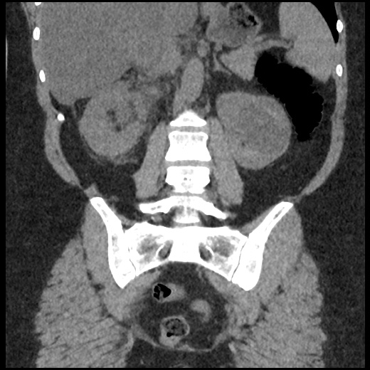Acute cholecystitis and ureteric colic (Radiopaedia 42330-45444 Coronal prone 68).jpg