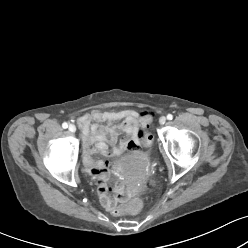 Acute cholecystitis with contained perforation (Radiopaedia 47328-51907 Axial C+ portal venous phase 66).png
