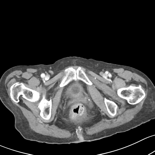 Acute cholecystitis with contained perforation (Radiopaedia 47328-51907 Axial C+ portal venous phase 73).png