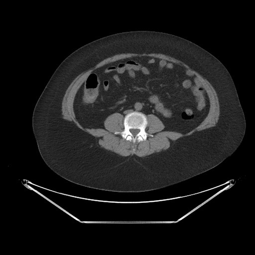 Acute cholecystitis with tensile fundus sign (Radiopaedia 71394-81723 Axial non-contrast 61).jpg