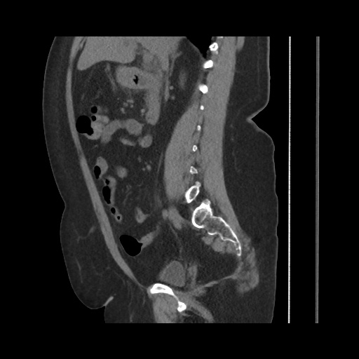 File:Acute cholecystitis with tensile fundus sign (Radiopaedia 71394-81723 Sagittal non-contrast 78).jpg